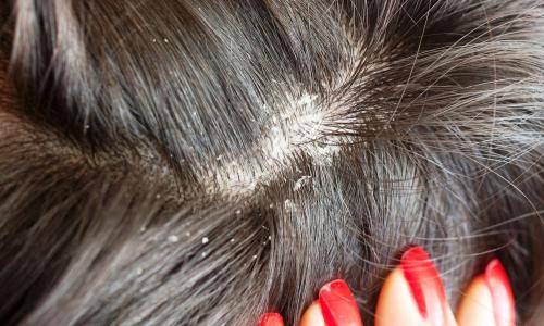 Рецепты простых и эффективных масок для волос против перхоти От перхоти и выпадения волос